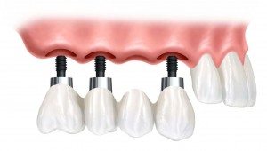 implantes dentales sevilla
