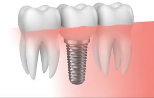 ¿Qué esperar de las nuevas técnicas en implantes bucales?