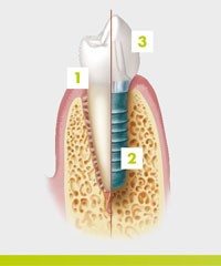 Si necesitas implantes dentales, este artículo te interesa