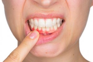 ¿Cómo cuidar de la salud de tus encías?
