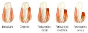 periodoncia