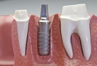 https://www.clinicadentallosboliches.com/