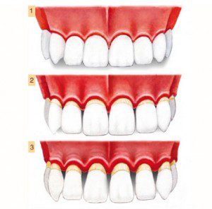 Todo lo que debes saber sobre la periodoncia