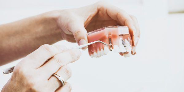 Implantes dentales en Sevilla y cuidado de la boca