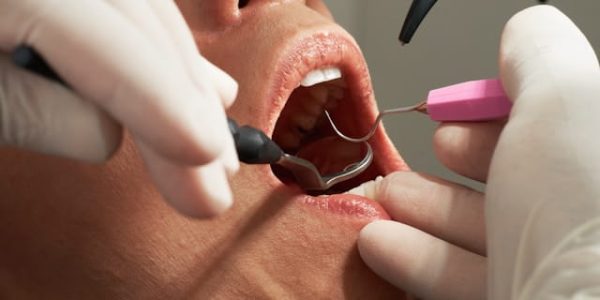 Modelo digital en tres dimensiones de una arcada dentaria obtenido por escáner intraoral en una clínica dental en Sevilla, planificando un tratamiento de ortodoncia invisible.
